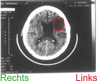 L&auml;sion bei einer Broca Aphasie